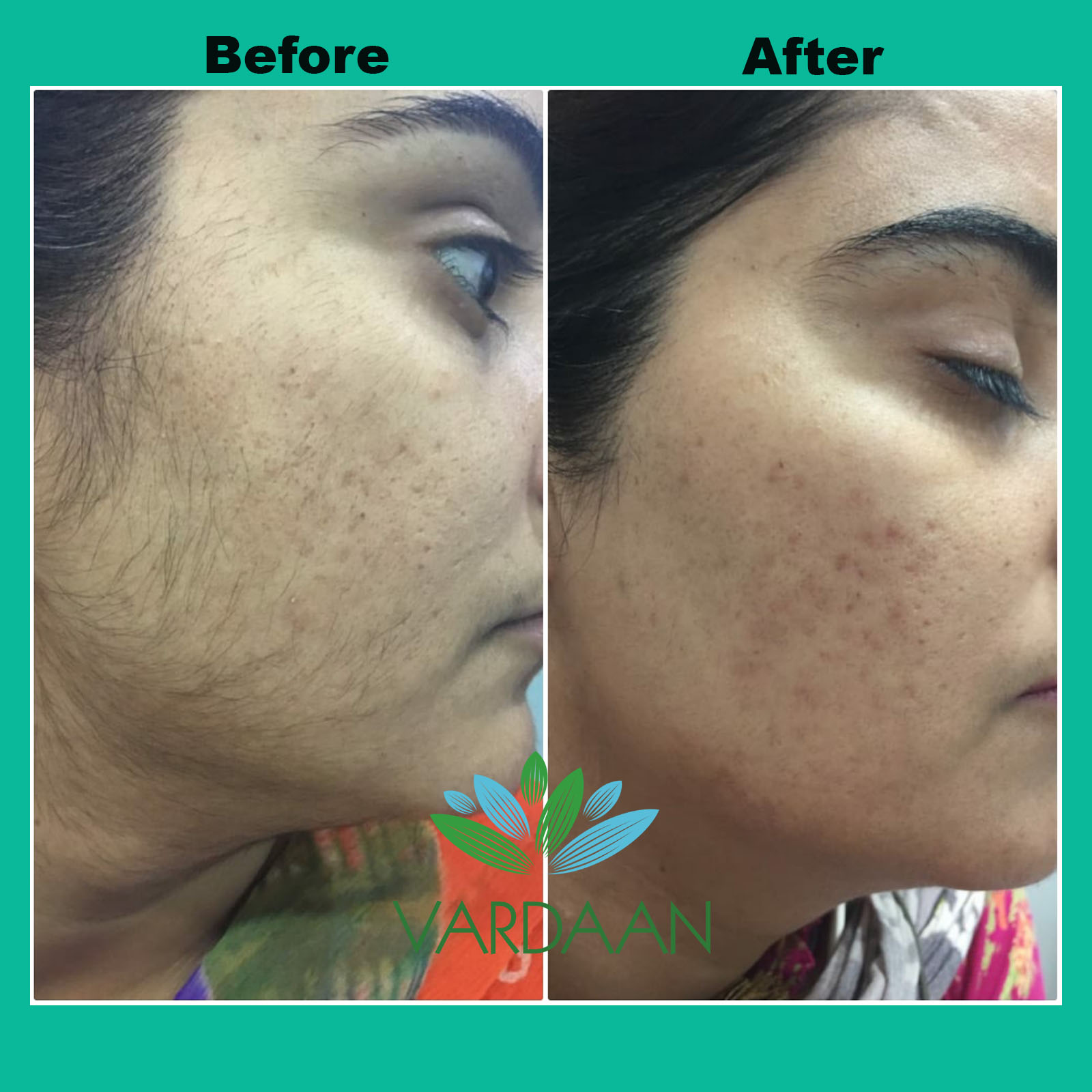 Laser Hair Removal Clinic In Delhi Full Body Laser Hair Removal Cost   1562247169a0a7cff3a52cc631e37780aa8e29b6a3 